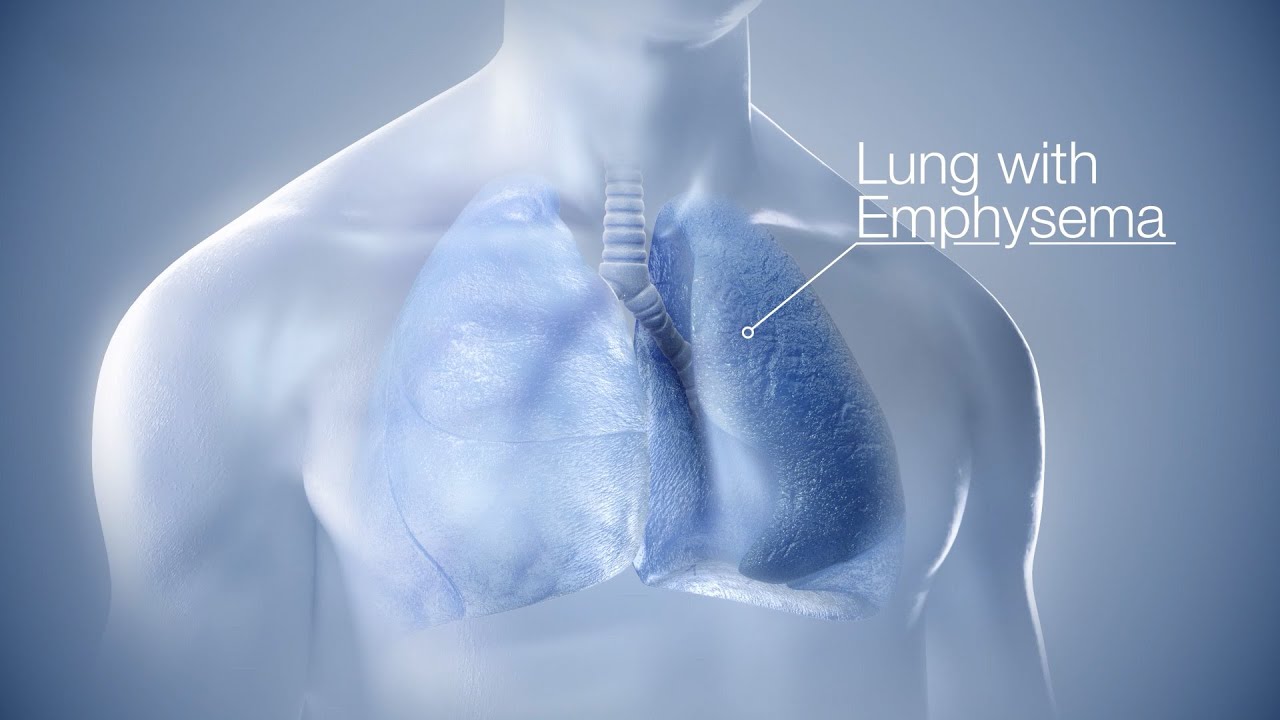 OLYMPUS Spiration Valve Air Leak Management (Medical 3D Animation)