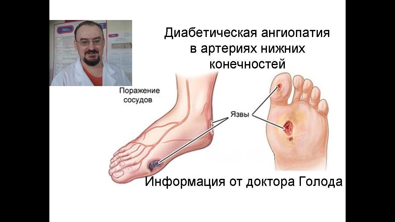 Диабетическая ангиопатия нижних конечностей. Её лечение.
