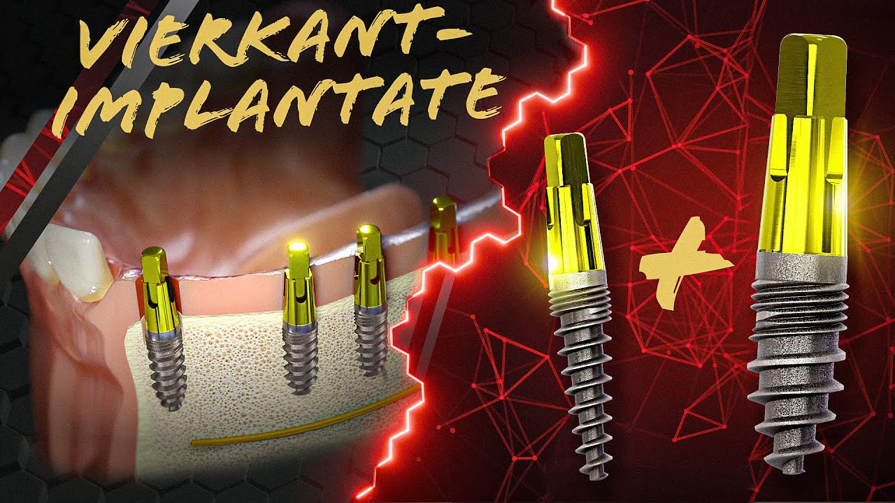 CHAMPIONS Vierkant-Implantate: Minimal-Invasive Technik im Fokus