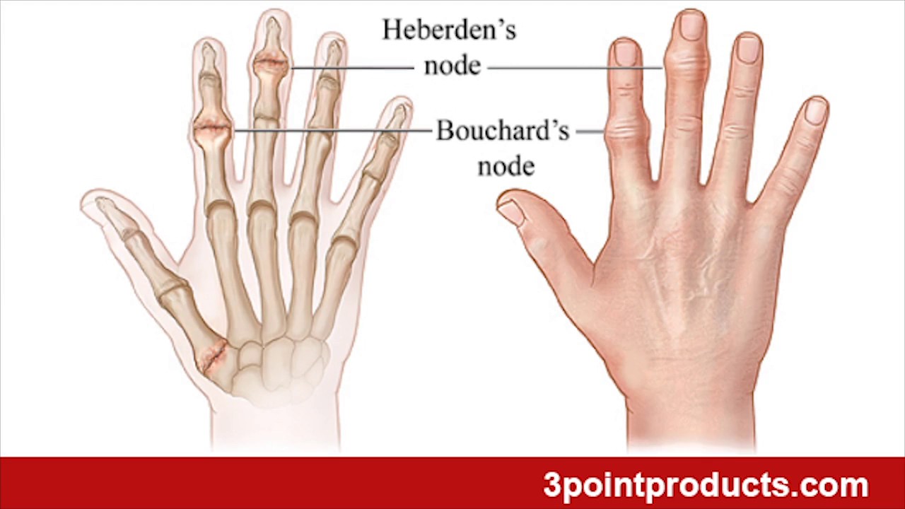 3PP Oval-8 Finger Splint