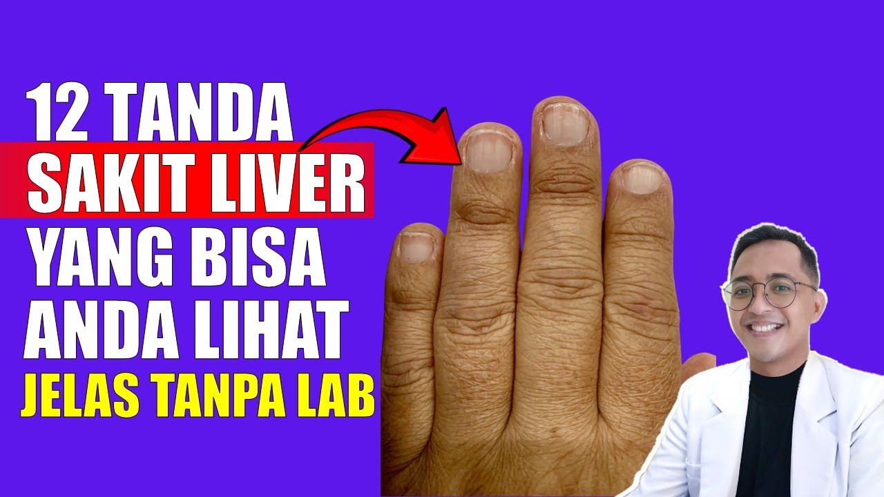 Tanda-Tanda Penyakit Liver (Hati) yang Terlihat dari Fisik Anda!