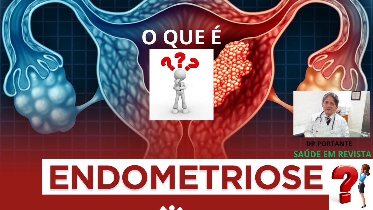 74 º SAÚDE EM REVISTA   ENDOMETRIOSE