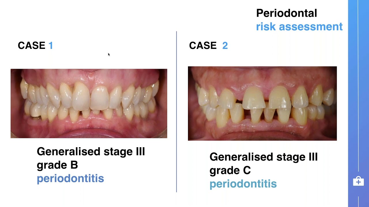 Symposium on stage I-III periodontitis treatment guideline - Yaman Altaep from Liège