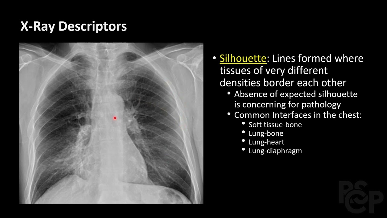 How to Read a Chest Xray - Approach to Chest X Ray - RSCP Video Curriculum