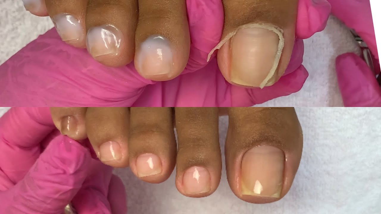 CUTILAGEM DOS PÉS