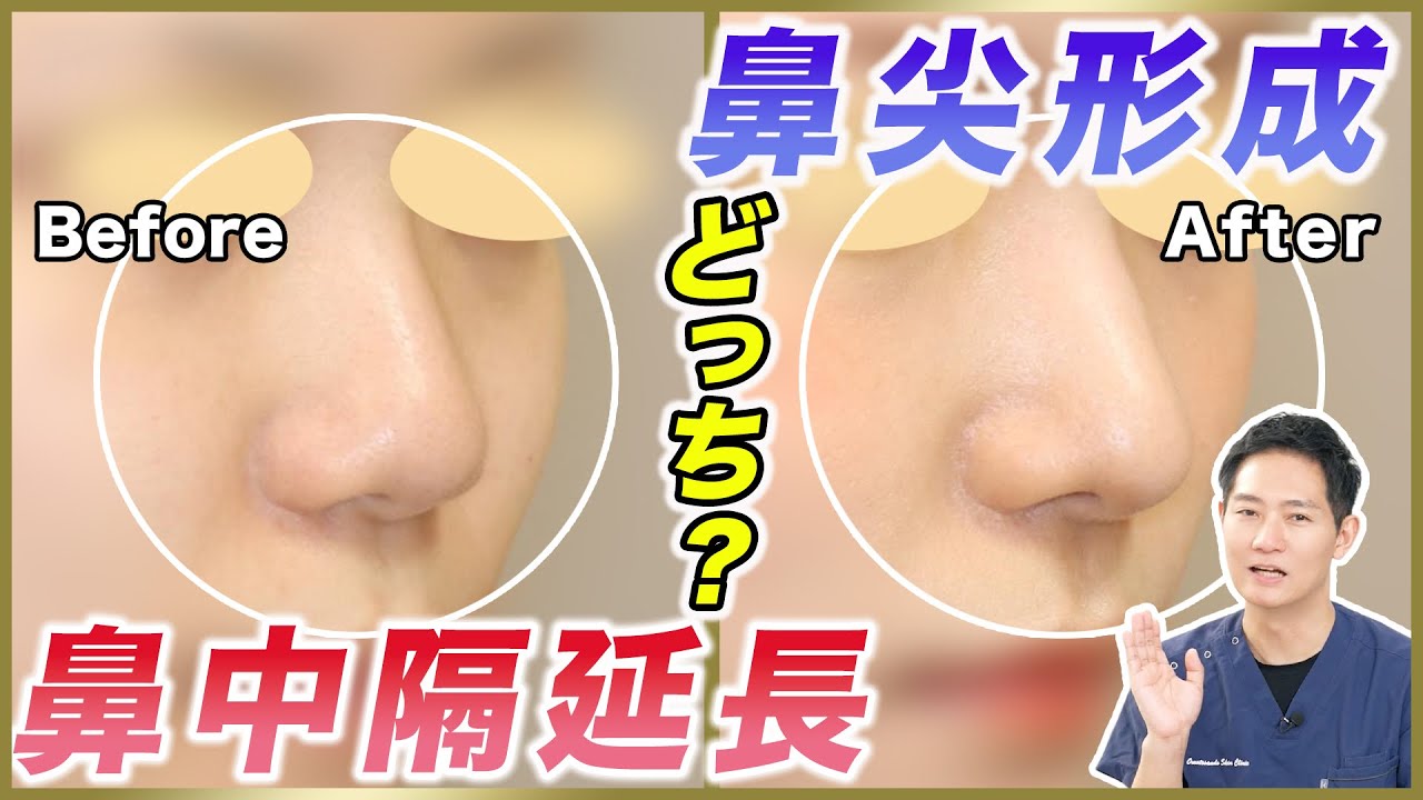 【鼻整形】症例で解説！鼻中隔延長とコルメラストラット法の違いについて