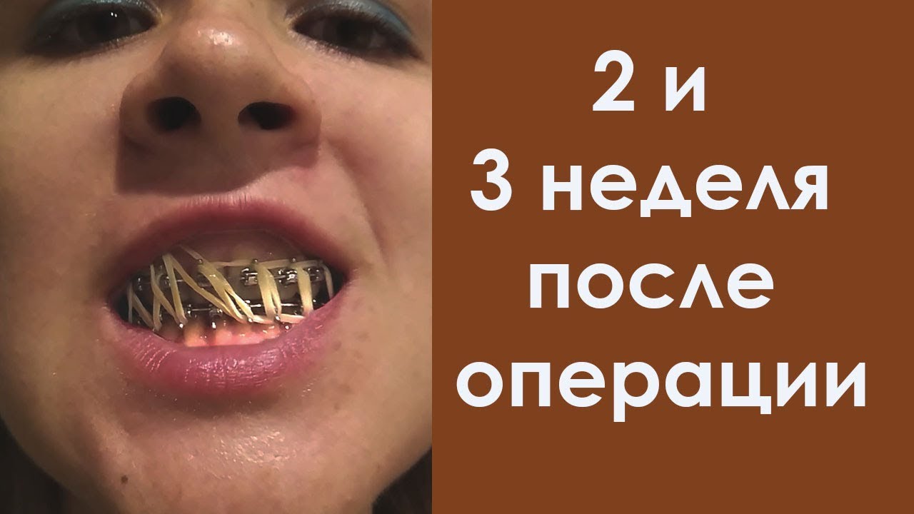 2 и 3 неделя после операции. Резинок всё больше