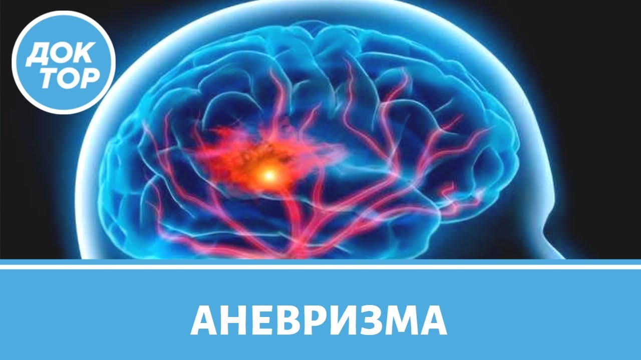 Аневризма сосудов головного мозга: кто в группе риска?