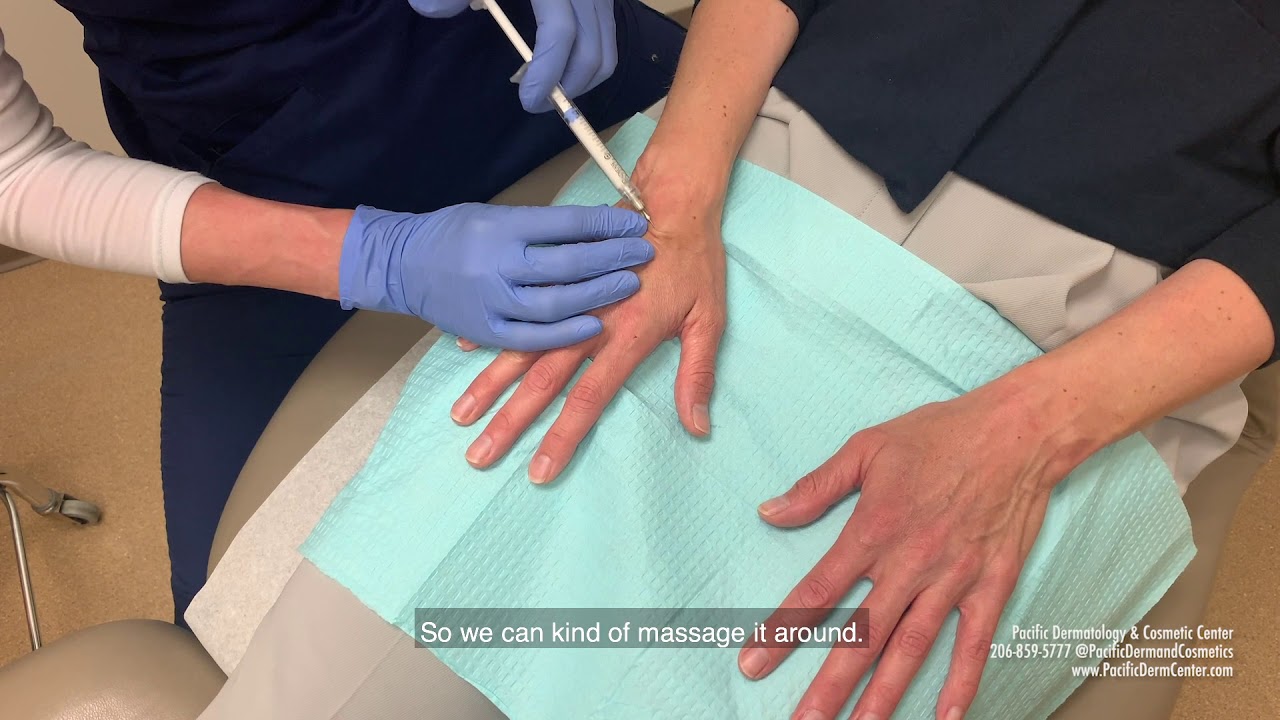 Demo Video: Hand Rejuvenation with Radiesse