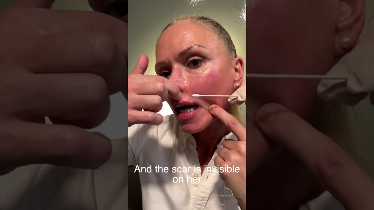Post Lip Lift- Lip Exercises by Dr Haworth