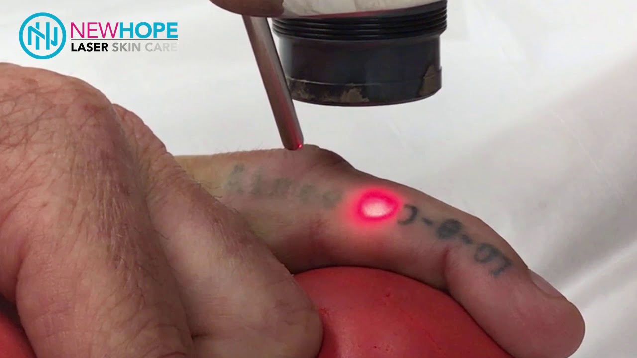 Laser Tattoo Removal - Removing a Finger Tattoo - Newhope Laser Skin Care - Orange County