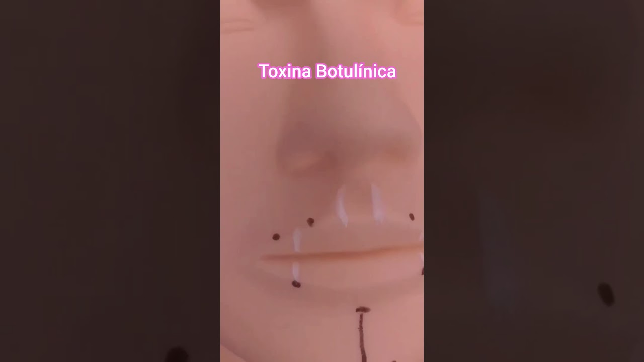 Como aplicar toxina Botulínica 