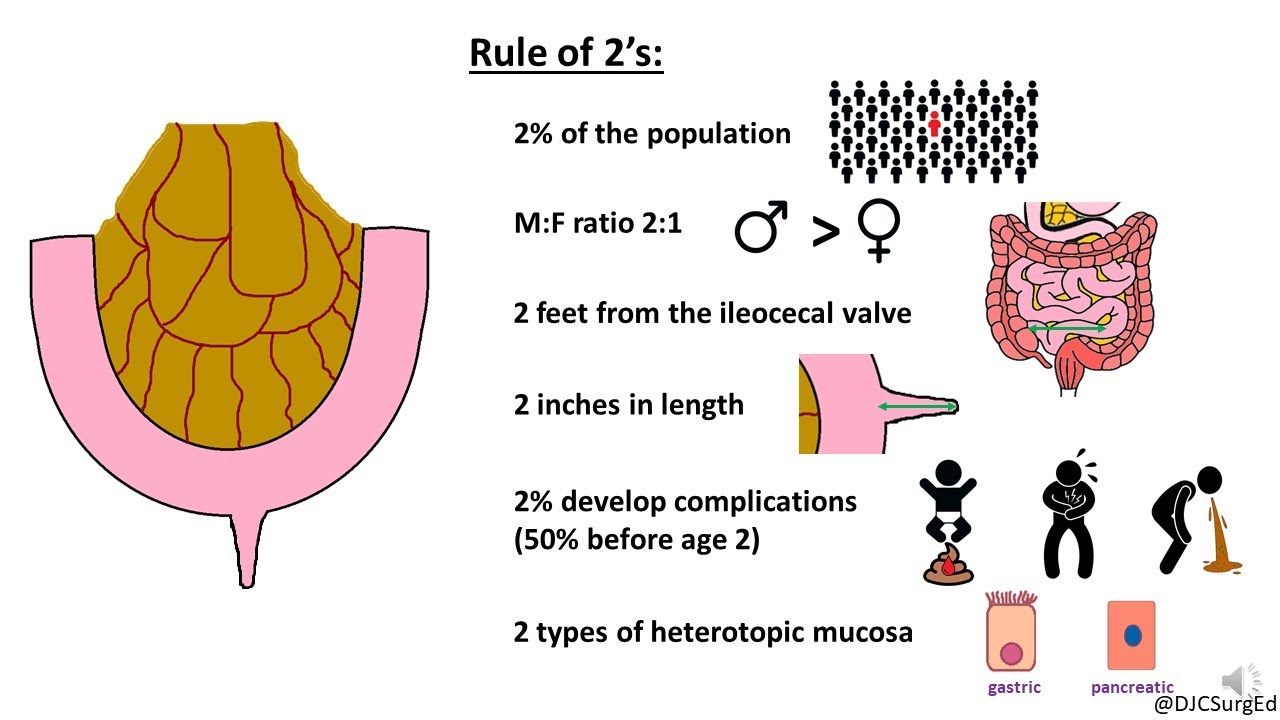 Meckel’s Diverticulum