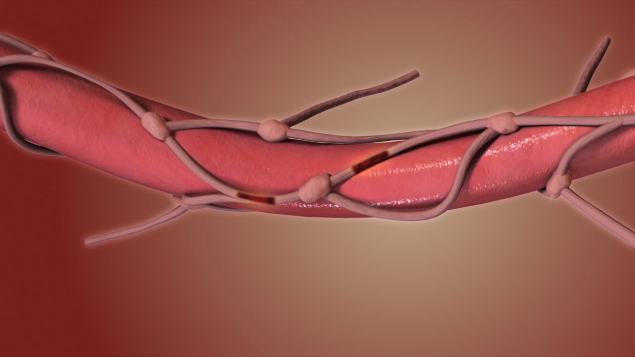 Esophagectomy. Esophagus Removal Animation