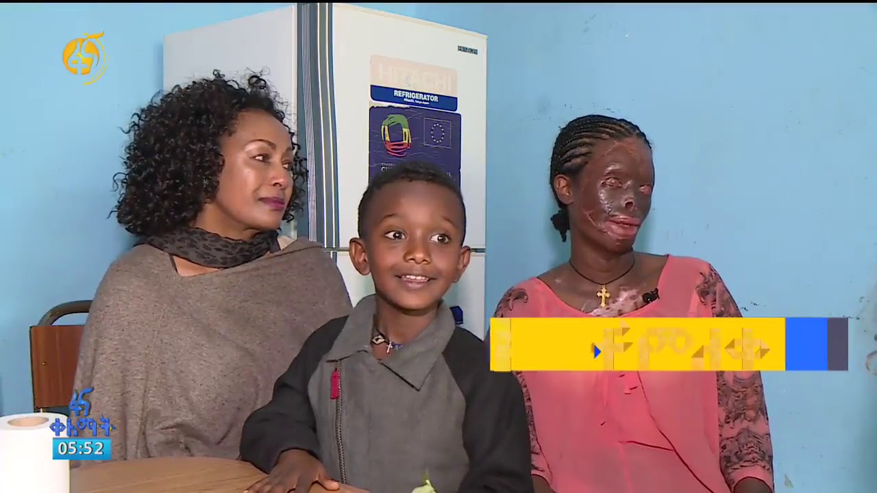አርቲስት መንበረ የደረሰችላት በባለቤቷ የአሲድ ጥቃት የደረሰባት  ወጣት