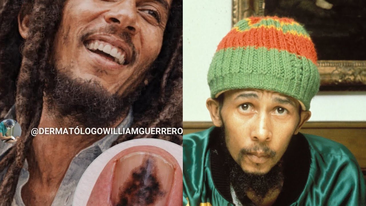 ¿Sabías que una pequeña mancha en la uña terminó con la vida de Bob Marley?
