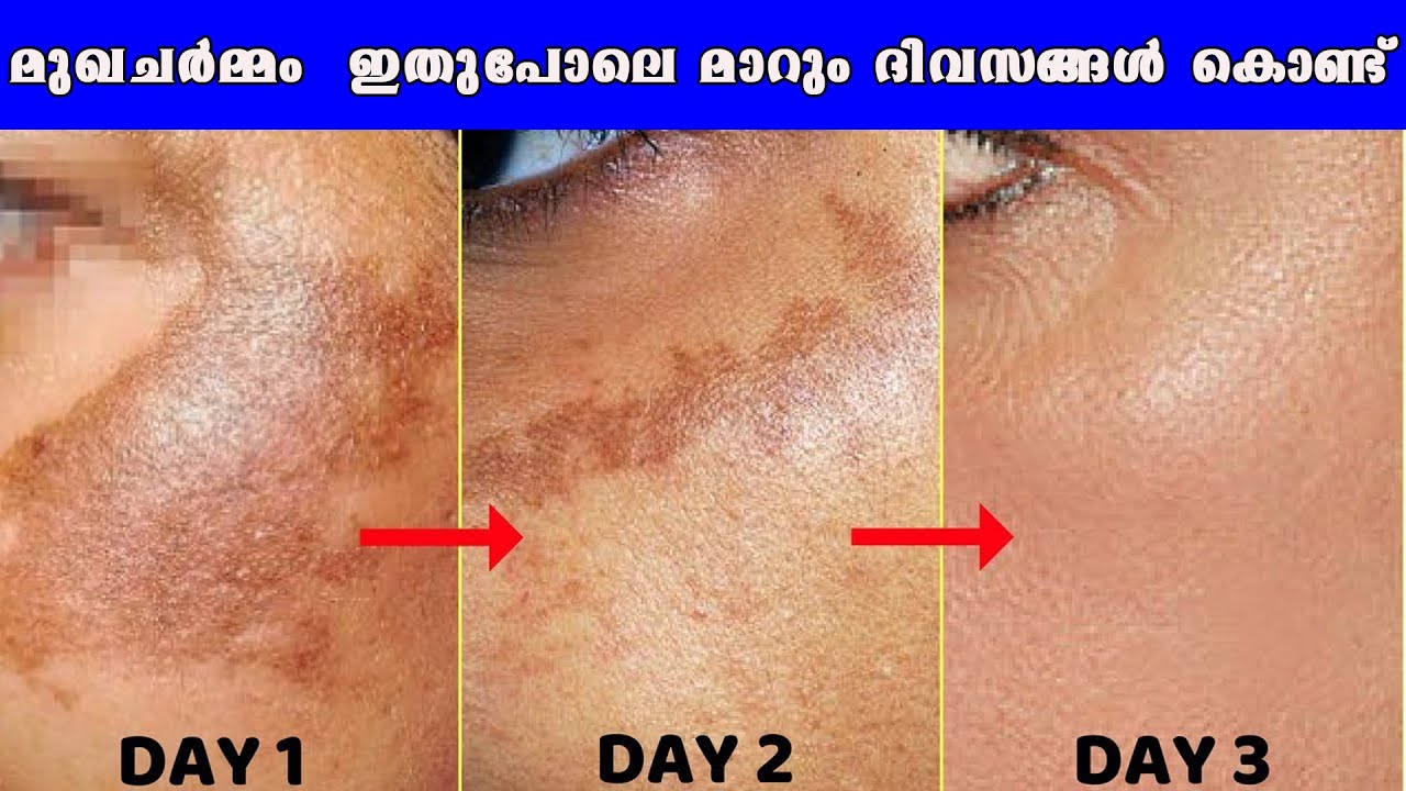 ഈ പ്രശ്നങ്ങള്‍ മാറാന്‍ ഇതിലും നല്ല പരിഹാരം സ്വപ്നത്തില്‍  മാത്രം Pigmentation and dark spots remedy