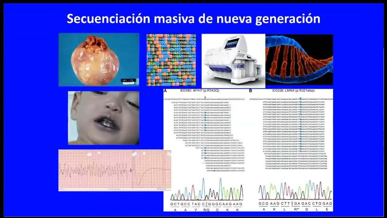 ESTUDIO Y TRATAMIENTO DEL PACIENTE CON SD DE QT LARGO - Dra. Norma Balderrabano