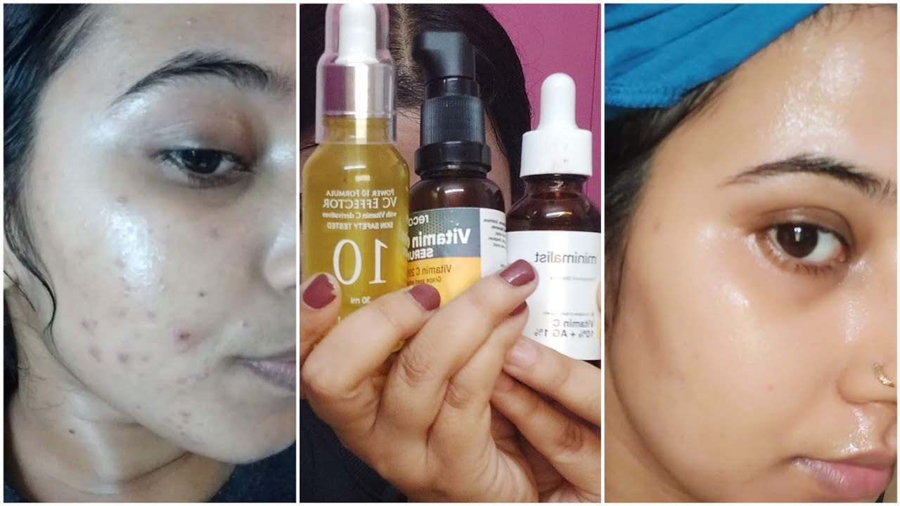 Best Affordable Vitamin C Serums to Remove Pimple marks, dark spots- Minimalist, Recast, It's Skin