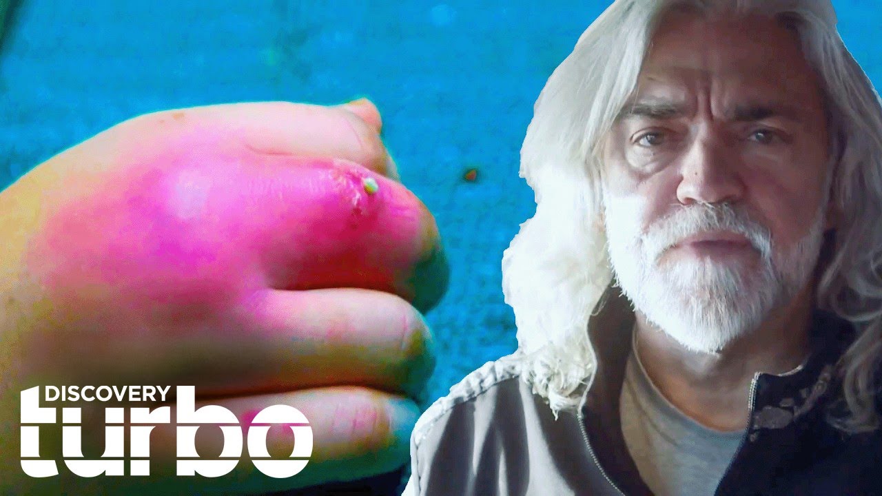 Crew Suffer From Broken Arms And PAINFUL Infections On The Bering Sea | Deadliest Catch