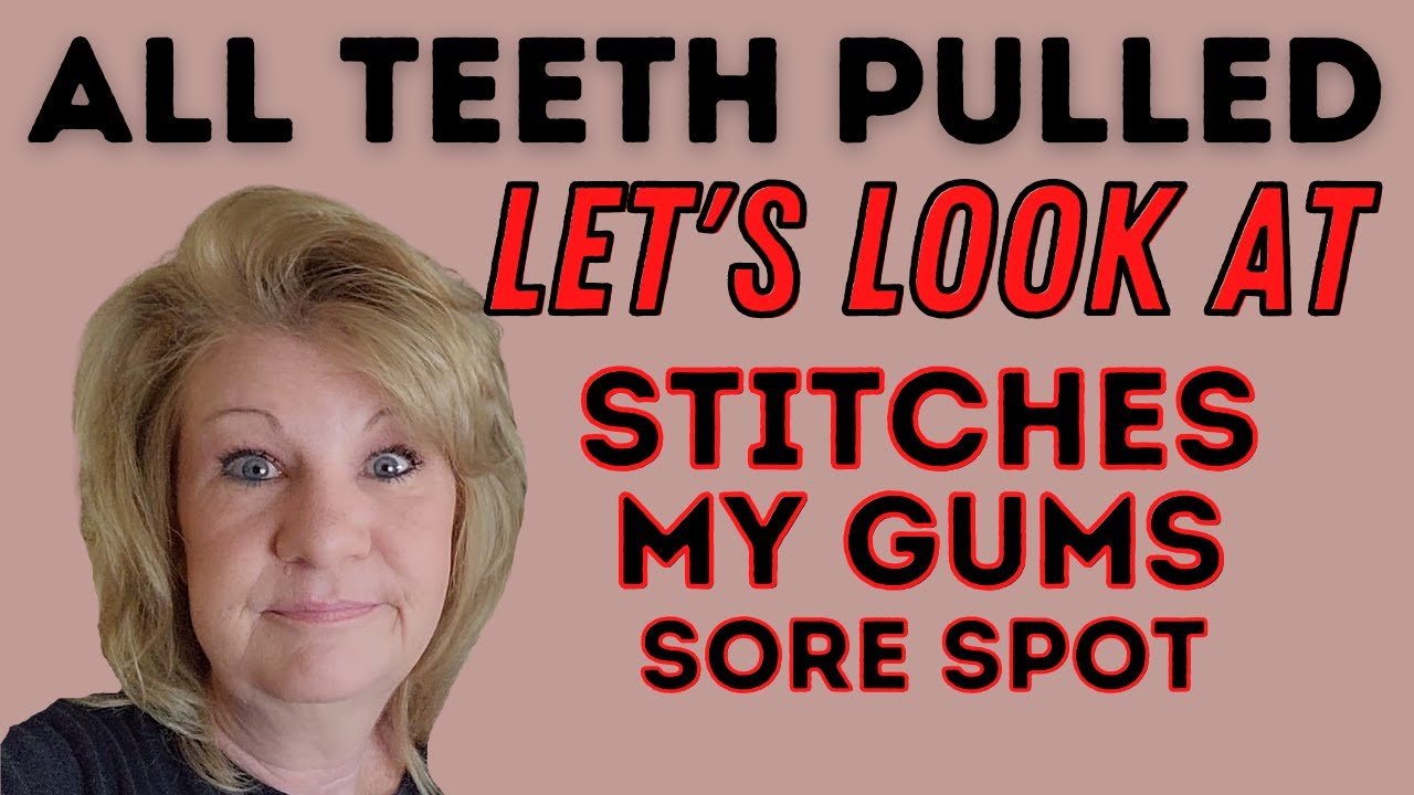 Immediate Dentures / Bad Sore From Dentures / Showing You My Gums Dentures Day 6