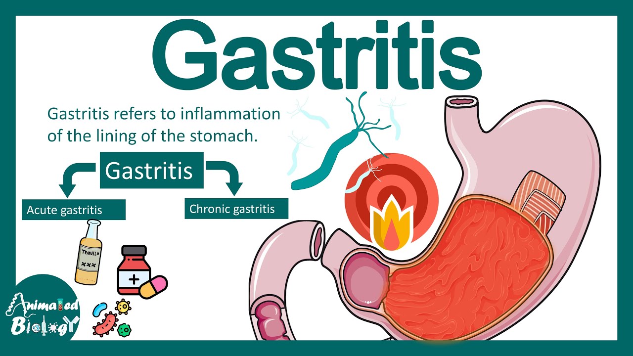 Gastritis | Pathology of gastritis | treatment of gastritis | USMLE step 1