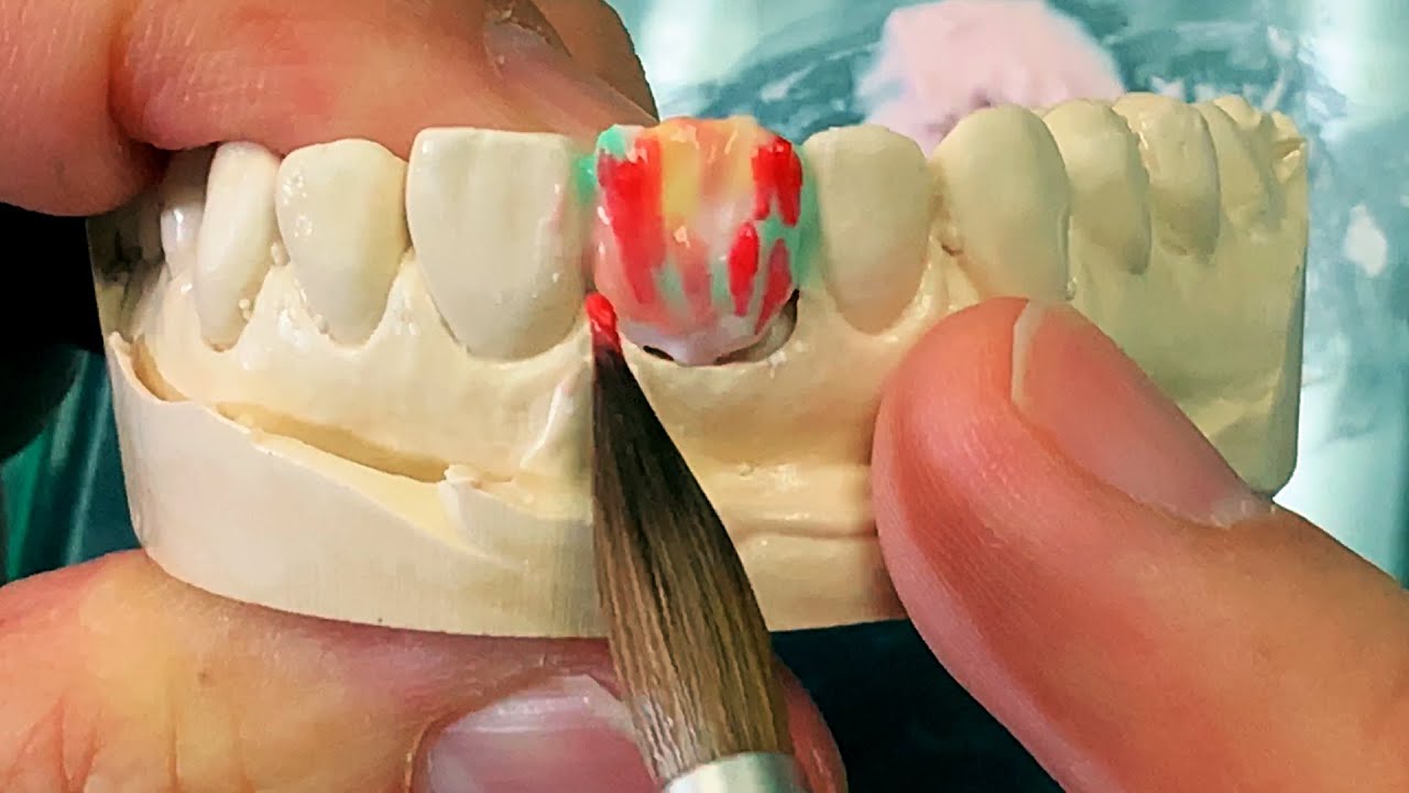 How To Match A Single Ceramic Tooth - Expert Method