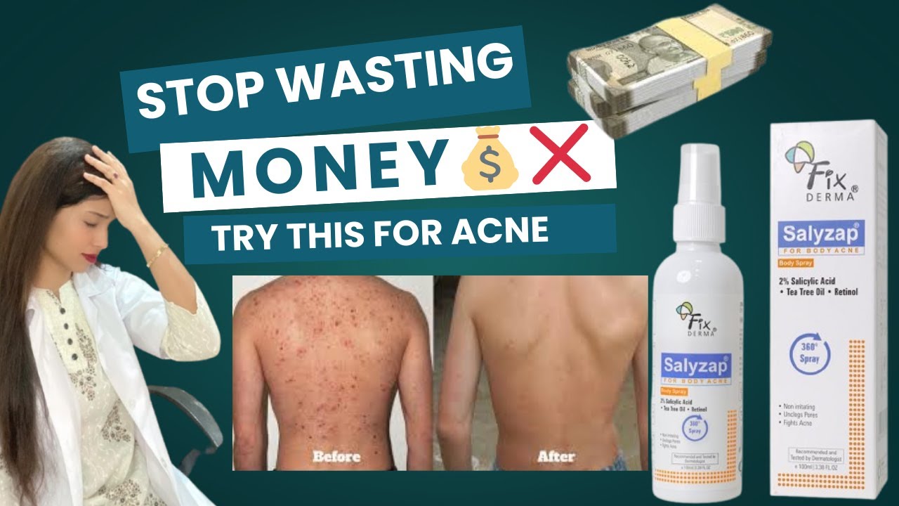 Fixderma Salyzap Body Spray – Say Goodbye to Body Acne! ✨
