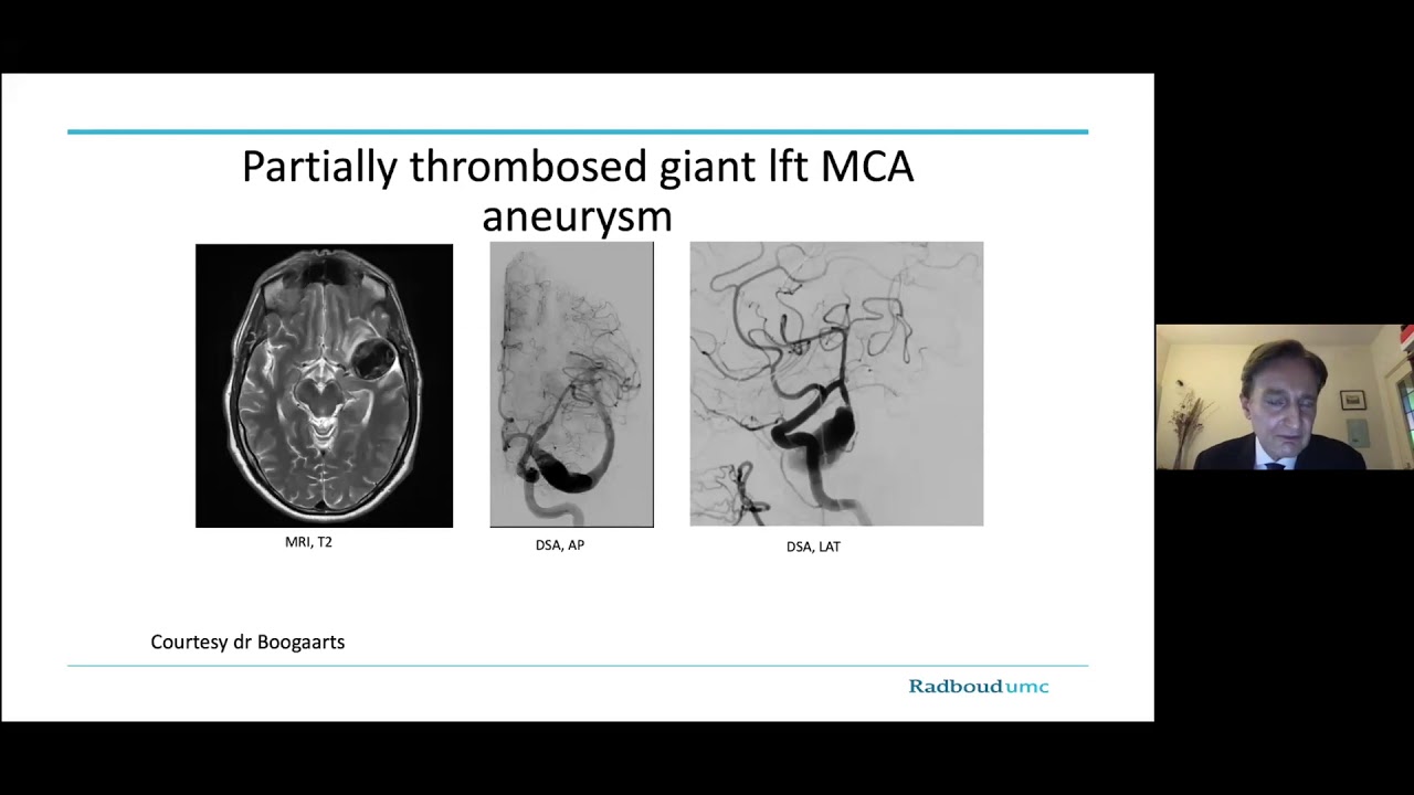 Middle Cerebral Aneurysms