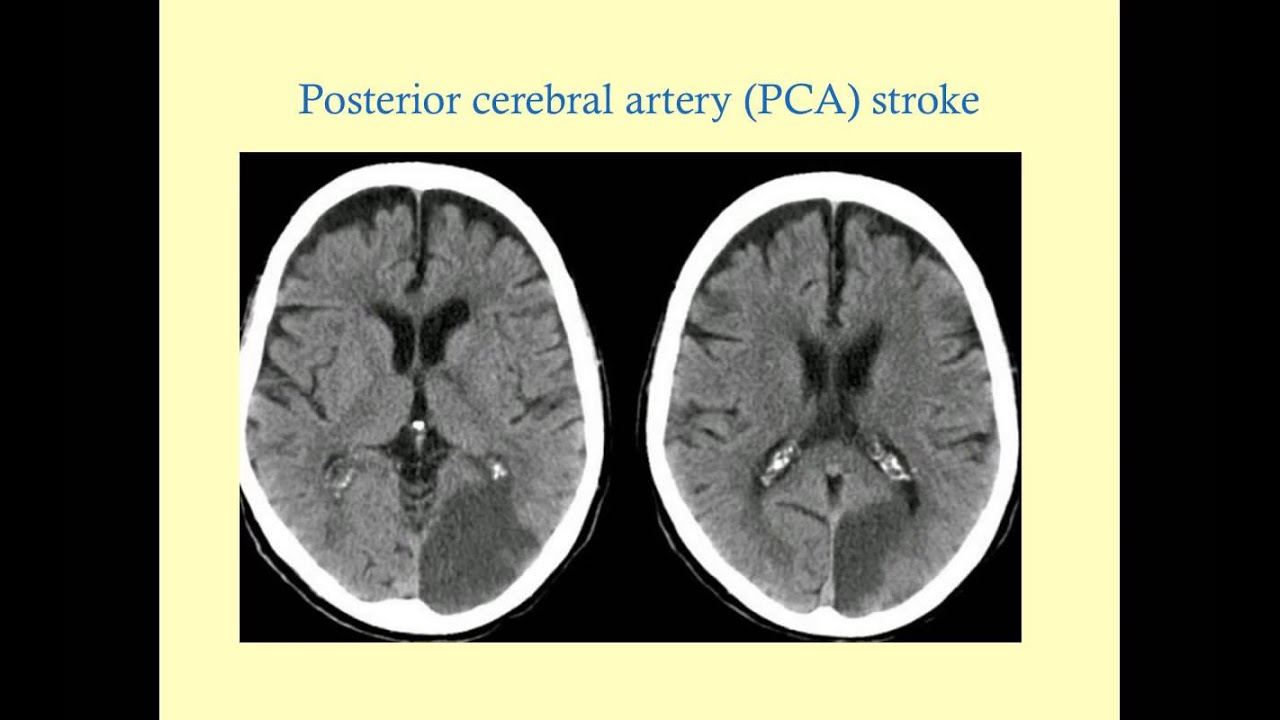 Stroke Syndromes (older version, with sound) - CRASH! Medical Review Series