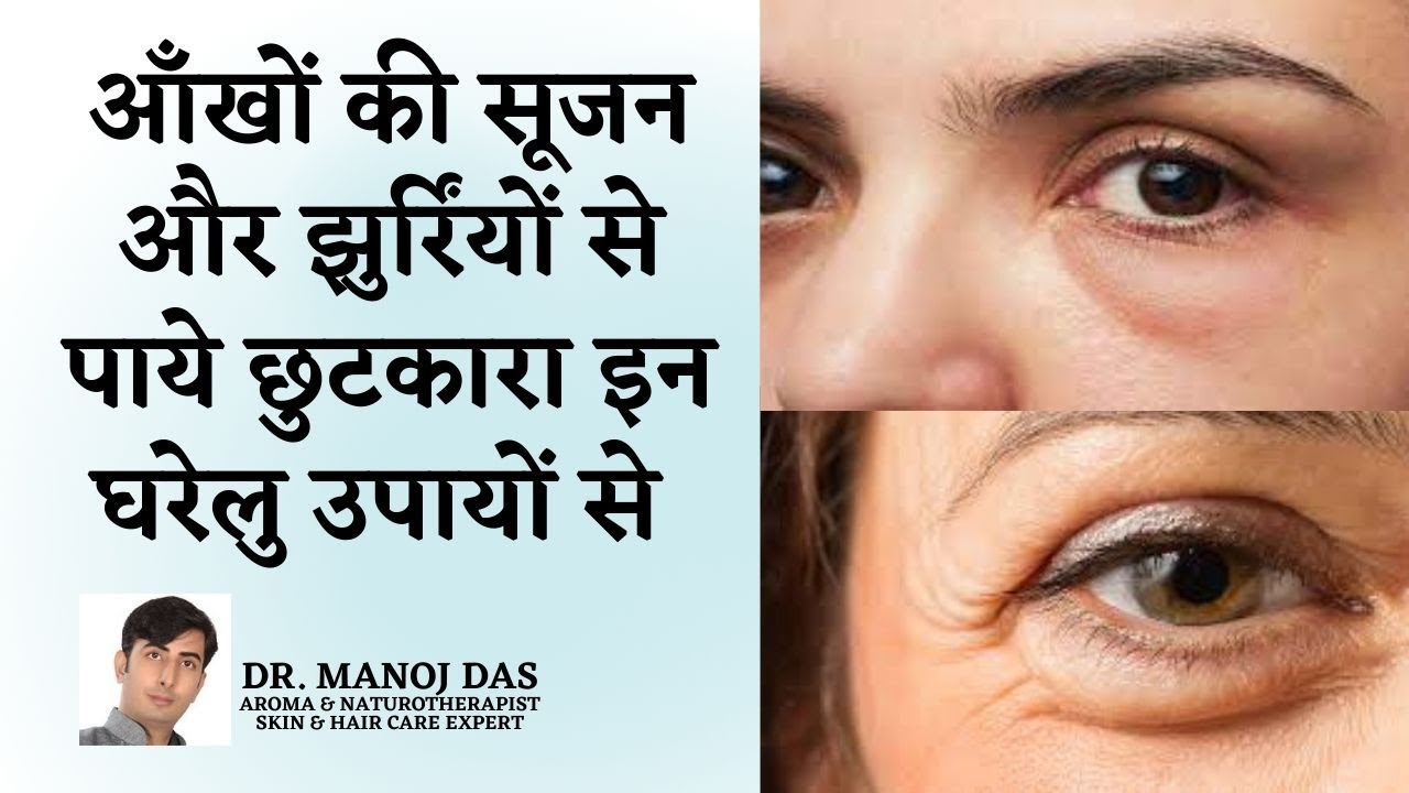 7 DAYS CHALLENGE : DIY SERUM To Remove PUFFY EYES PERMANENTLY in 1 WEEK | DR. MANOJ DAS