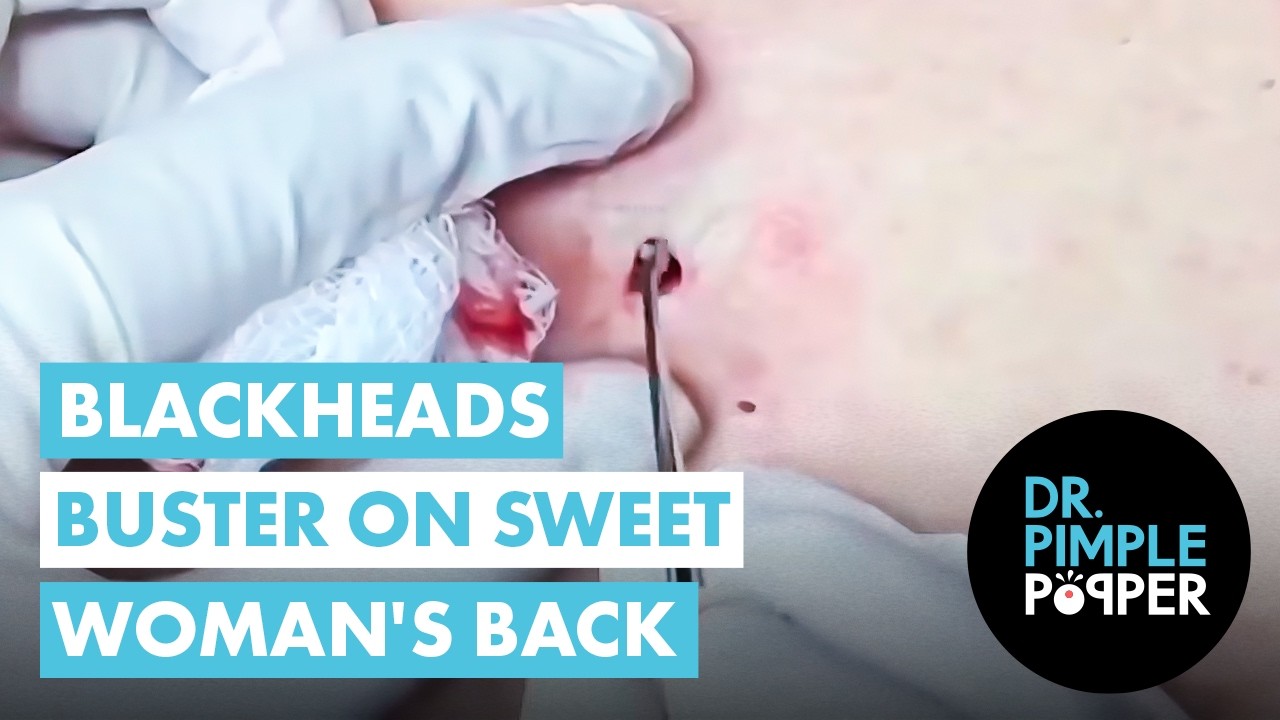 Blackhead Buster on Sweet Woman's Back