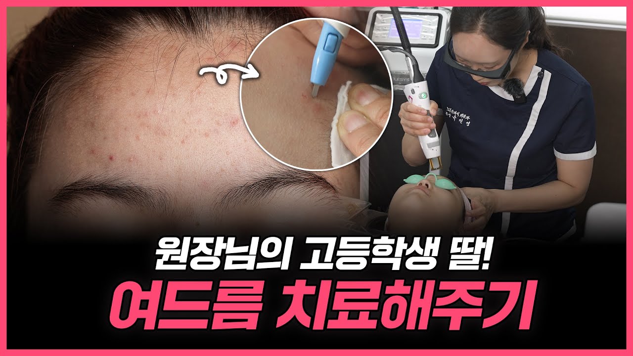 의사 선생님 고등학생 딸의 여드름 치료 리얼 후기 (네오빔+아그네스)