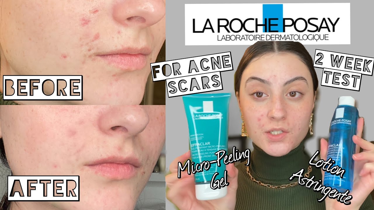 TESTING LA ROCHE POSAY EFFACLAR Lotion Astringent & Micro-Peeling Gel  for ACNE SCARS