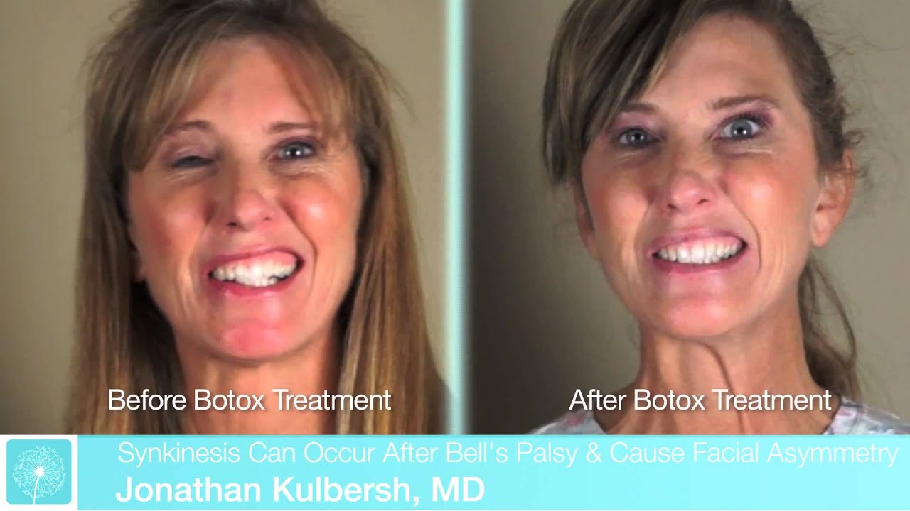 Botox For Bell's Palsy | Bell's Palsy Treatment | Dr. Kulbersh