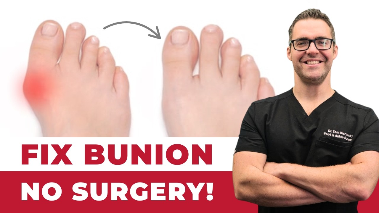 Bunion Home Cure [WOW] Stretches, Exercises & Correctors *NO Surgery*