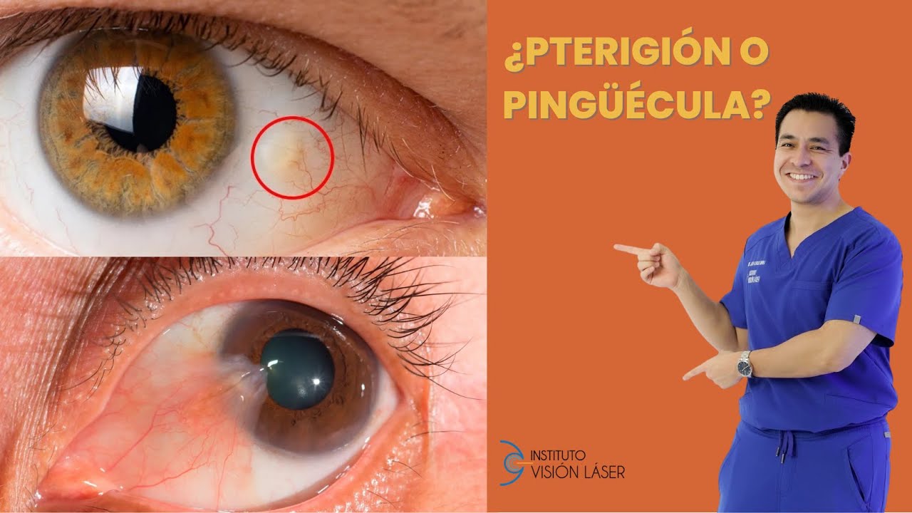 PTERIGI&Oacute;N O PINGU&Eacute;CULA