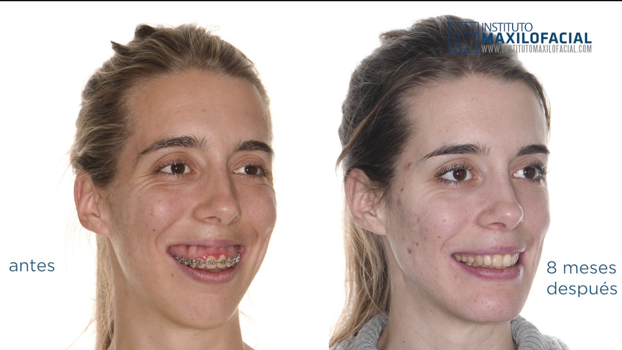 Cirugía ortognática bimaxilar. Mentoplastia. Caso #39: Marina - Clase 2, sonrisa gingival
