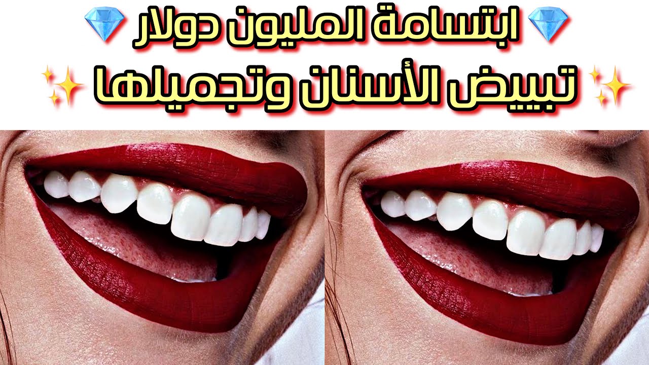 ابتسامة المليون دولار 💸 تبييض الاسنان🦷ابتسامة هوليود💎(إستمع مره واحده)بتقنية DR🚀