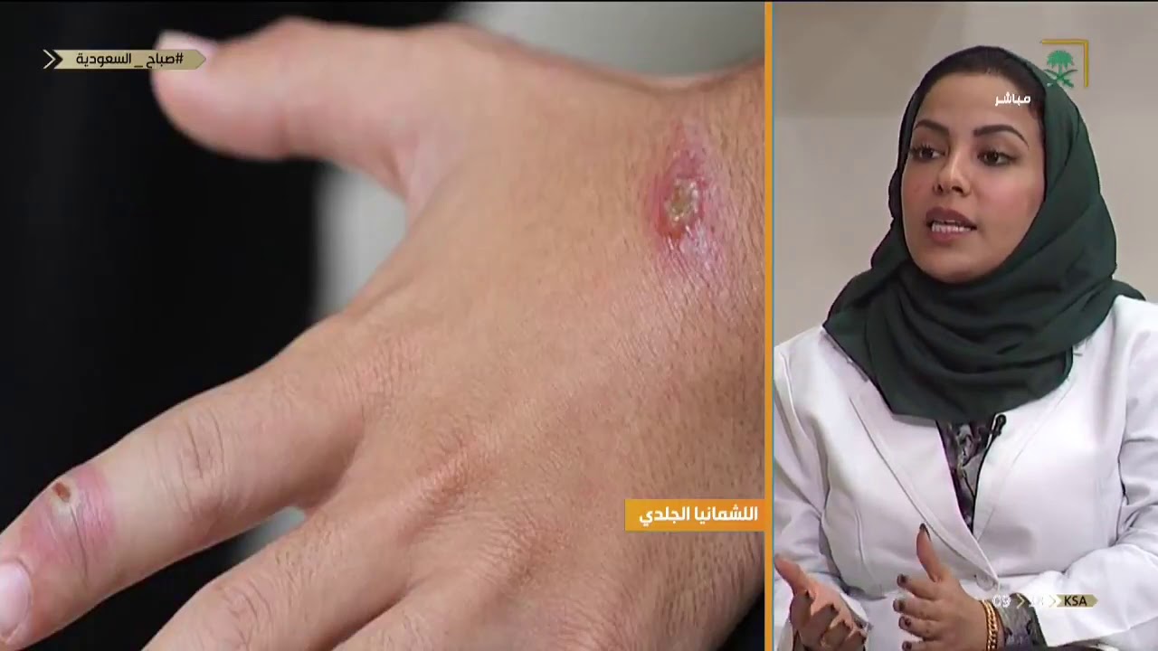 ما هو داء الليشمانيا الجلدي وأعراضه ؟ مع د. سلمى العجلان - بورد جامعة الملك سعود في الجلدية والتجميل