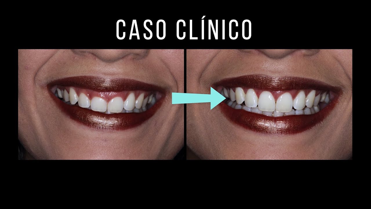 Cirurgia plástica gengival: GENGIVOPLASTIA