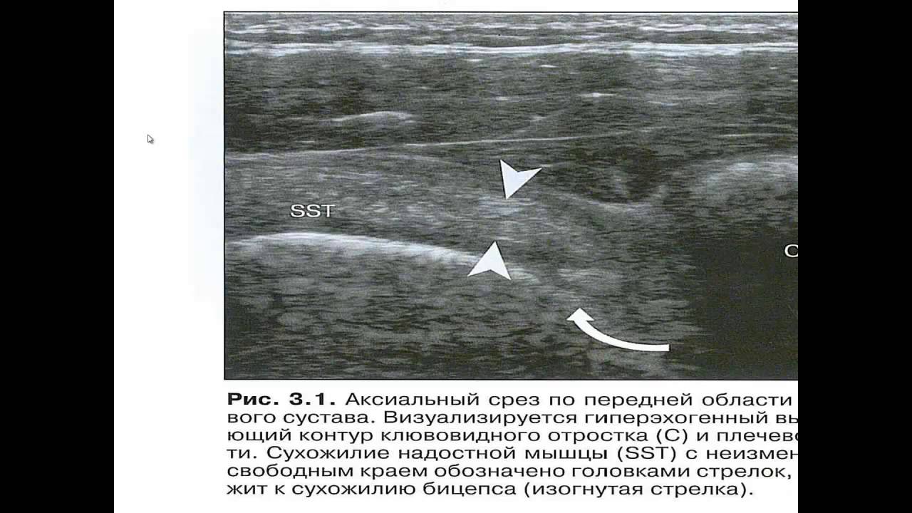 УЗИ плечевого сустава