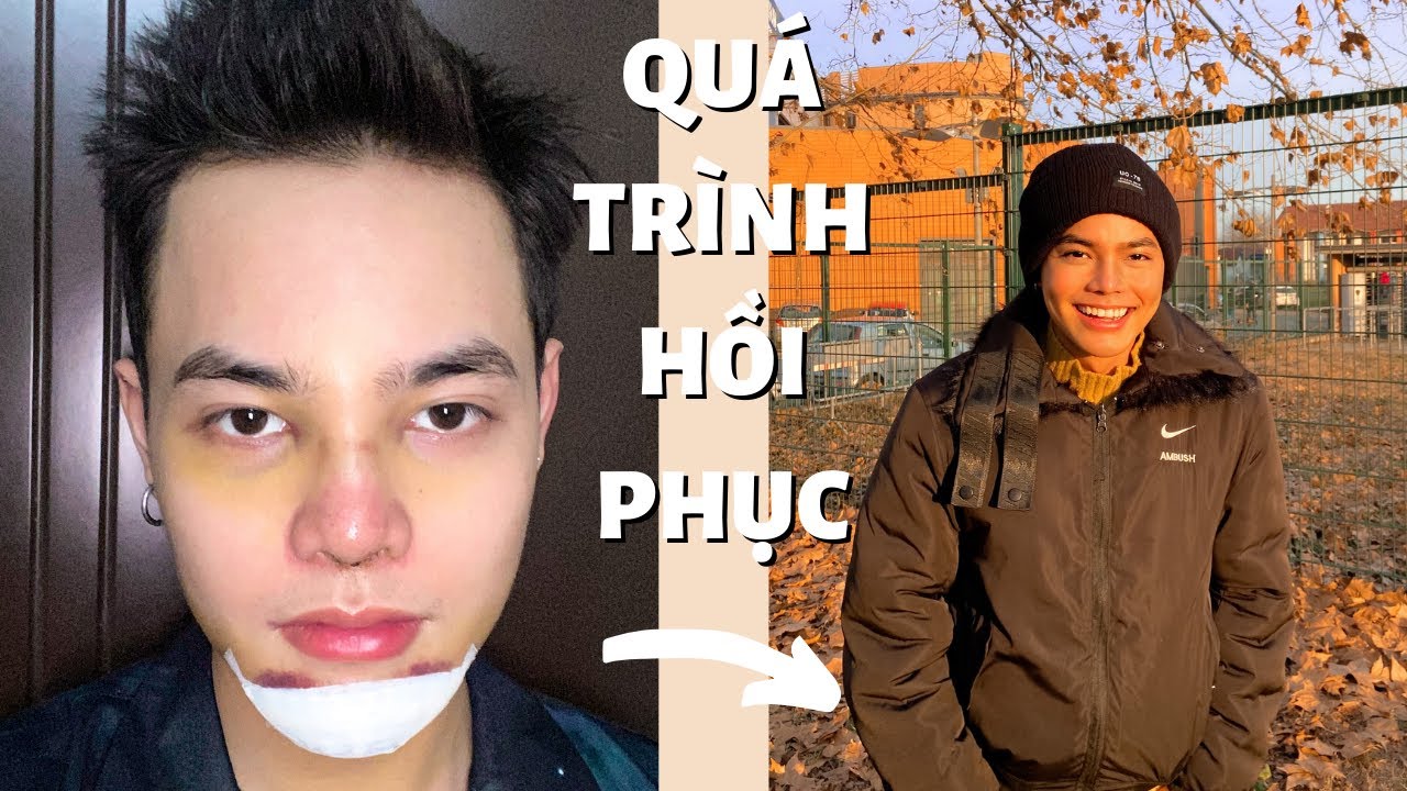 PHẪU THUẬT THẨM MỸ (quá trình hồi phục) | Sửa mũi 2 lần và lằm cằm | Plastic surgery | (Part2)