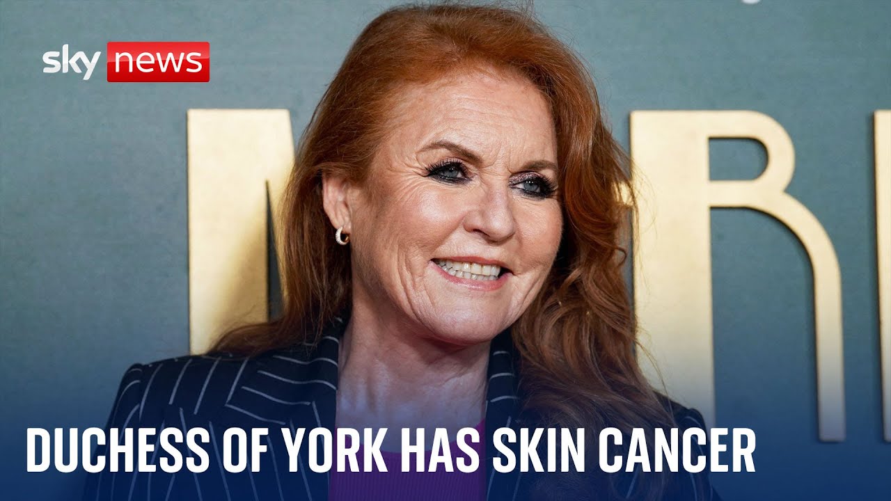 Duchess of York Sarah Ferguson is receiving treatment for skin cancer