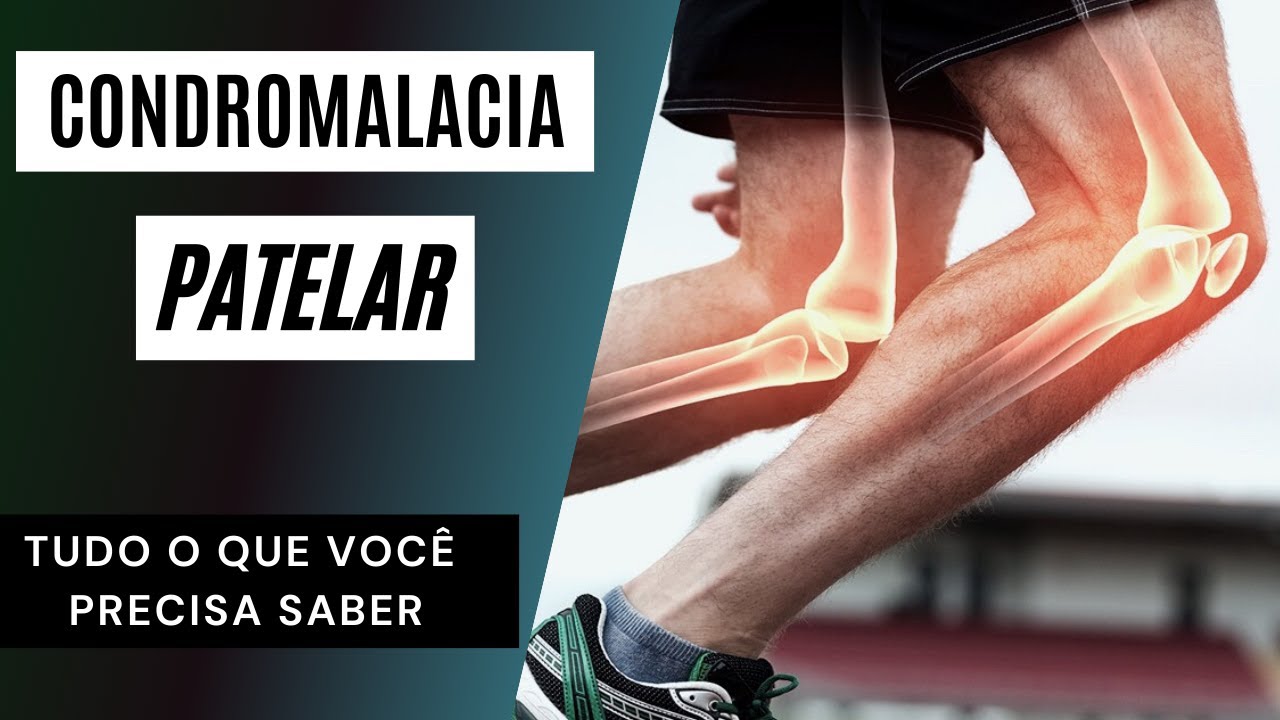 CONDROMALACIA PATELAR: TUDO O QUE VOCÊ PRECISA SABER