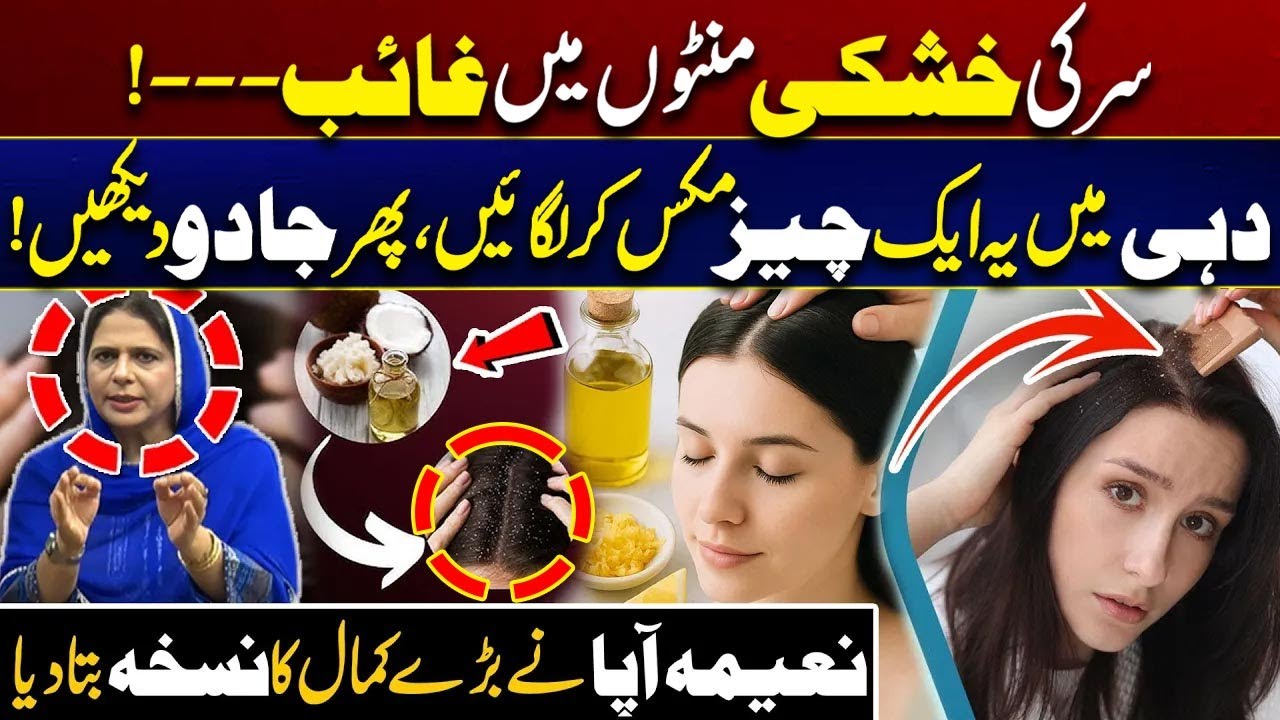 Home Remedies for Dandruff | Natural Dandruff Removal Hack | City 41