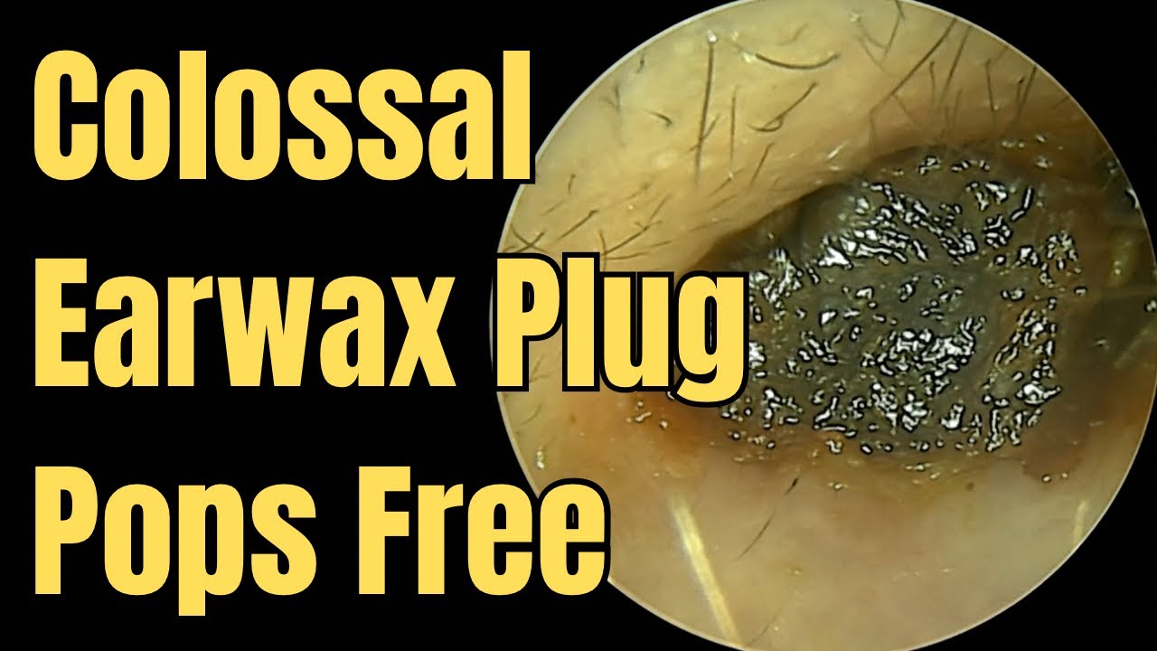 Colossal Earwax Plug Pops Free