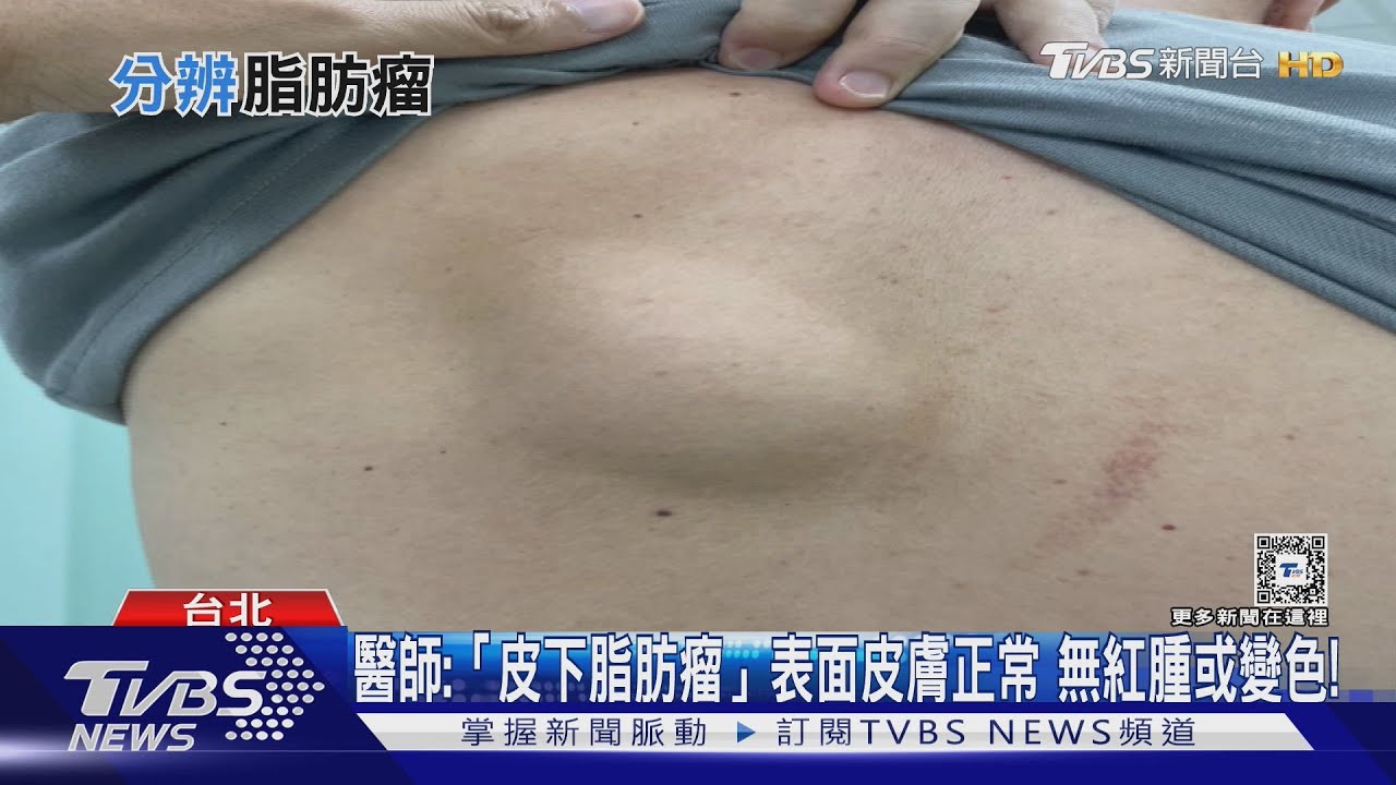摸起來接近圓形...不痛..無紅腫..「腫瘤」長在身體「這幾處」醫師:速就醫檢查判定....｜十點不一樣20241119 @TVBSNEWS01