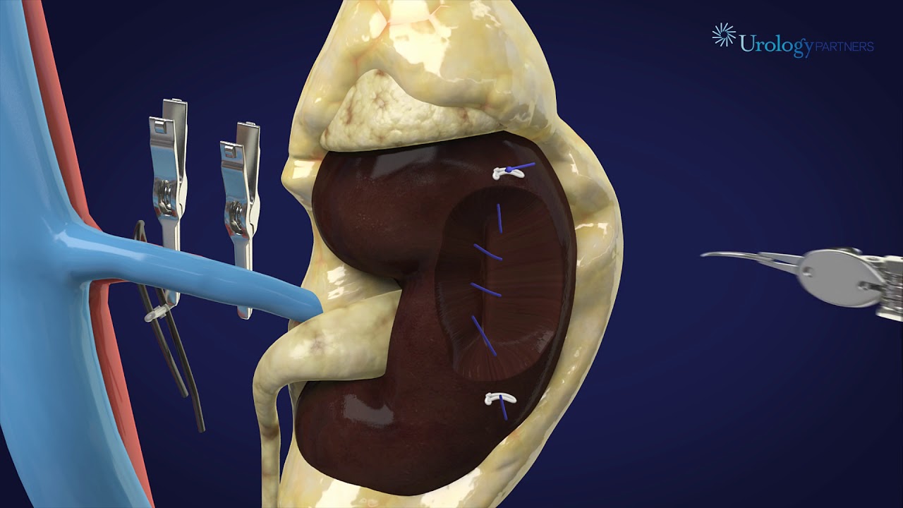 Robot-Assisted Partial Nephrectomy for Kidney Cancer and Benign Kidney Tumors