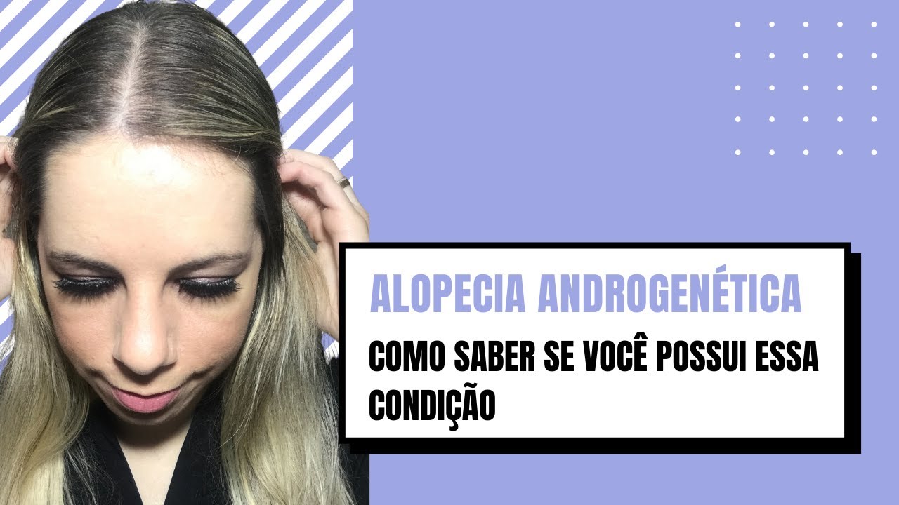 Como saber se tenho alopecia androgenetica? Quais são os sintomas?